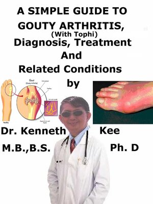 cover image of A Simple Guide to Gouty Arthritis (With Tophi), Diagnosis, Treatment and Related Conditions